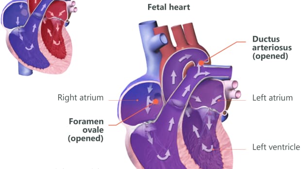patent-ductus-arteriosus-pediatric-heart-defect
