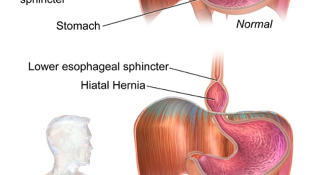 hiatal-hernia-facts