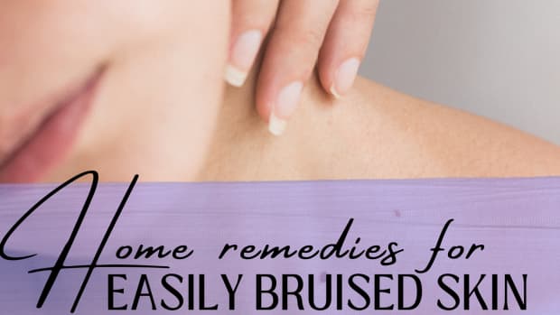 easy-bruising-and-thin-skin-the-causes-and-some-self-help-ideas
