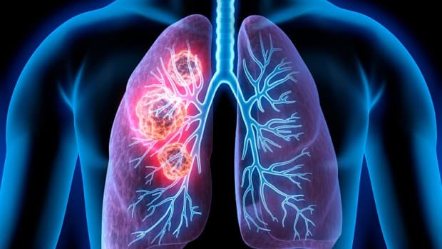 lesser-known-risk-factors-for-lung-cancer