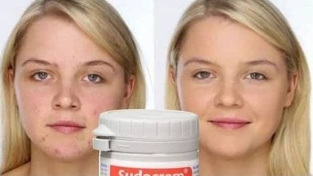 sudocrem-uses-and-benefits-on-acne-prone-skin