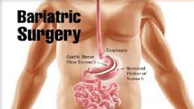 bariatric-surgery-the-path-to-your-dream-body