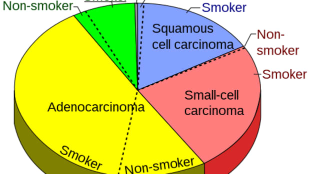 what-do-you-know-about-lung-cancer