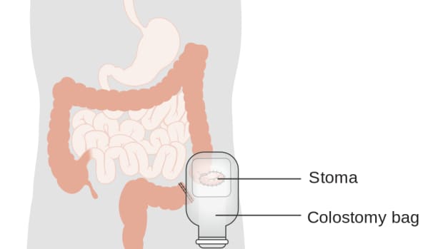 colostomy_managing-colostomy_after-colon-surgery