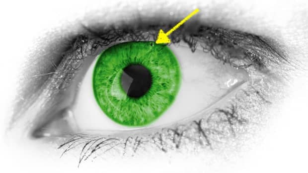 laser-glaucoma-treatment