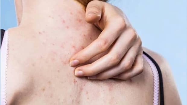 home-remedies-to-get-rid-of-back-acne