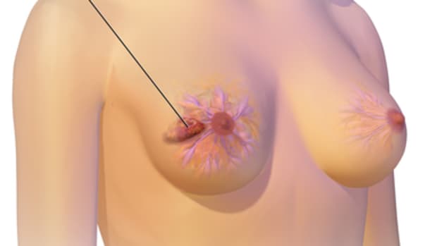 breast-cancer-risk-factors-symptoms-treatments