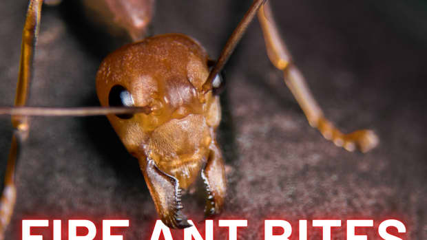 how-to-treat-fire-ant-bites