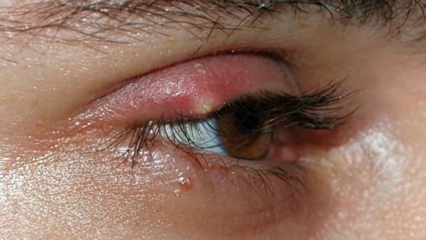 3-fast-solutions-to-treat-a-mosquito-bug-bite-on-the-eyelid