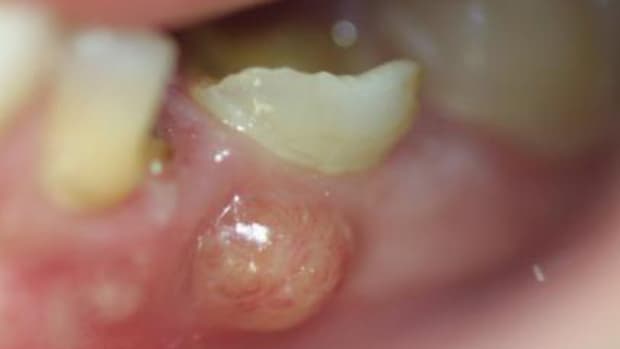 how-to-drain-a-gum-abscess-at-home-without-a-needle