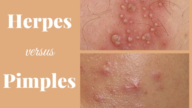 Sexually Transmitted Infections Advice Info YouMeMindBody   What Does Herpes Look Like Does Herpes Look Like A Pimple 