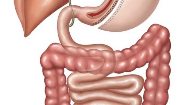 pros-and-cons-of-gastric-sleeve-weight-loss-surgery