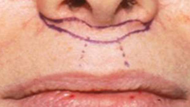 lip-enhancement-augmentation