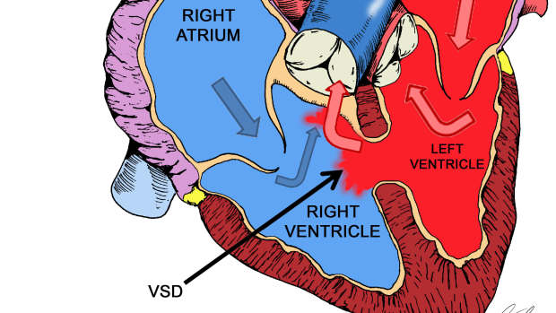 left-to-right-shunt-lesions-ventricular-septal-defect-vsd
