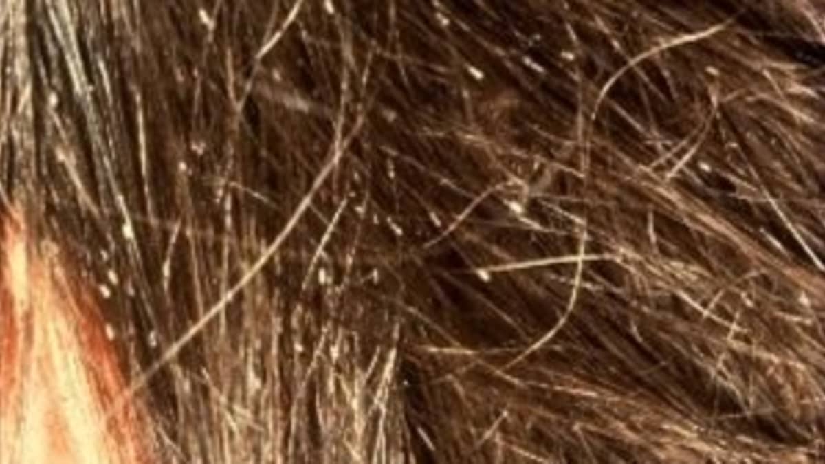 How to Get Rid of Head Lice and Nits With Vinegar and Conditioner