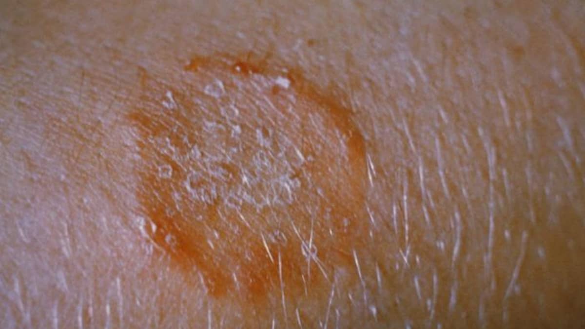 does ringworm spread on dogs