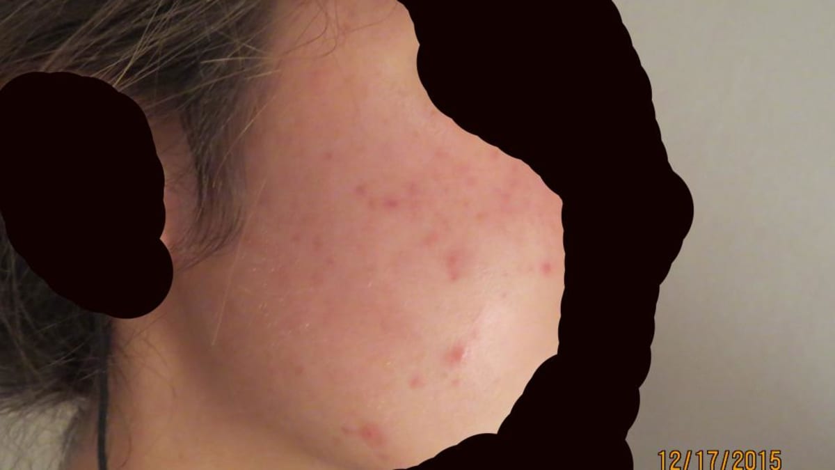 My Experience With Accutane for Acne: The Female Perspective - YouMeMindBody
