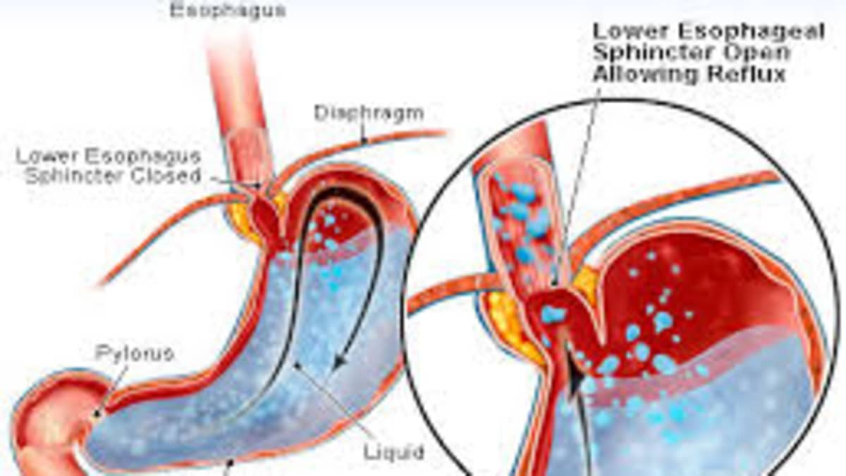Coping With GERD (Gastro-Esophageal Reflux Disease) - HubPages