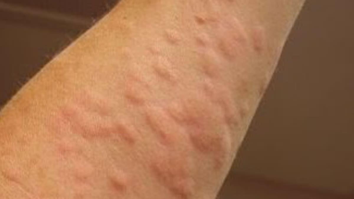 allergic reaction hives home remedies