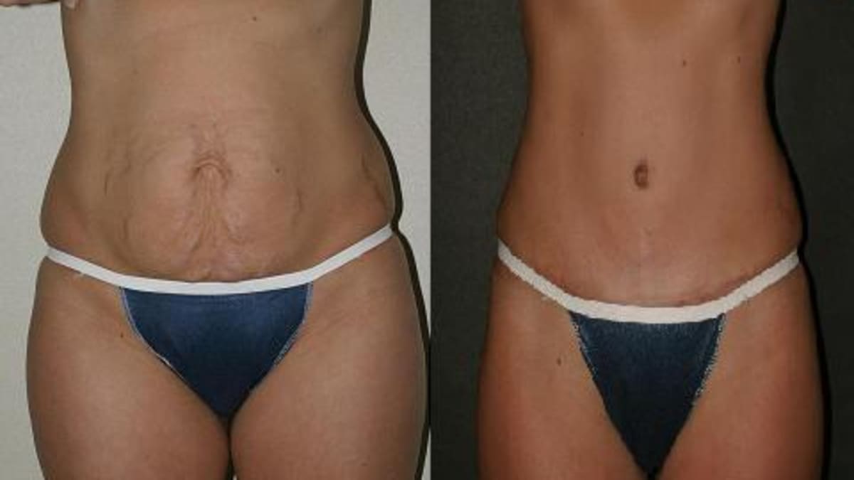 Mini Tummy Tuck (Partial Abdominoplasty): Procedure, Recovery Time, and  Cost - HubPages
