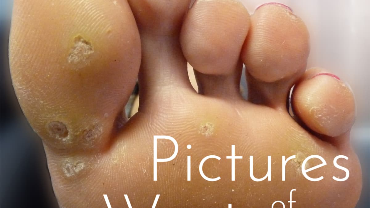 My Experience With Warts Causes Home Treatments And Pictures Patient S Lounge