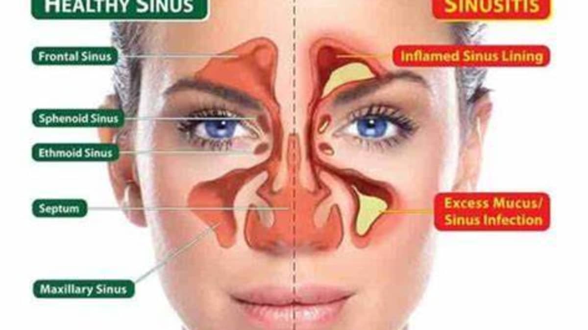 9 Natural Ways to Relieve Sinus Pressure