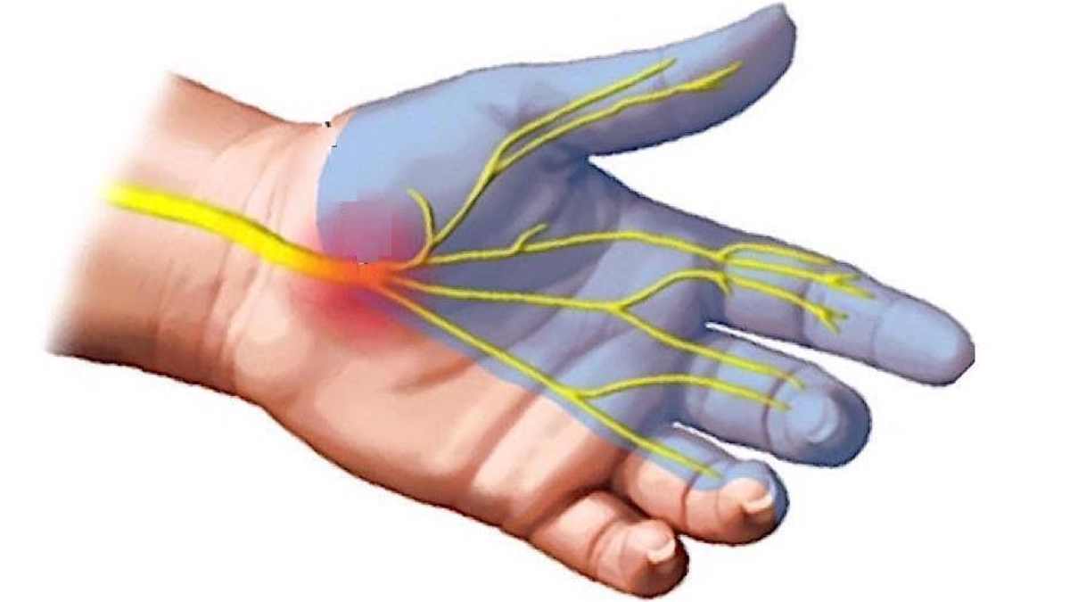 How My Doctor Misdiagnosed Carpal Tunnel Syndrome - HubPages how-my-doctor-misdiagnosed-carpal-tunnel-syndrome-hubpages
