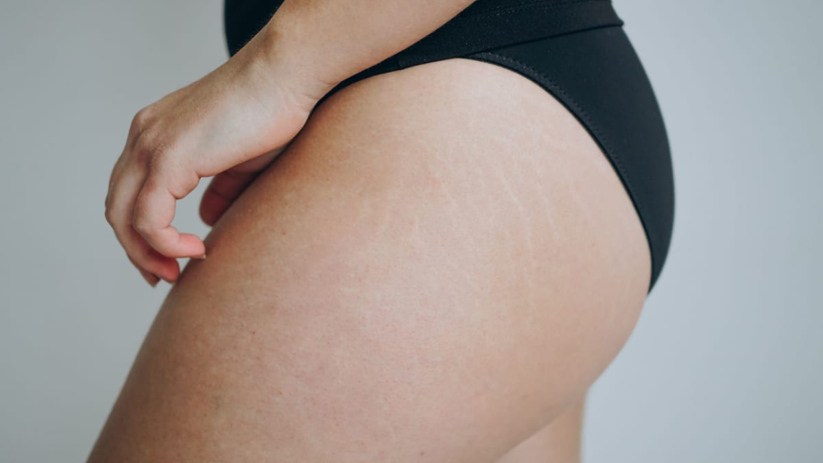 keratosis pilaris buttocks causes