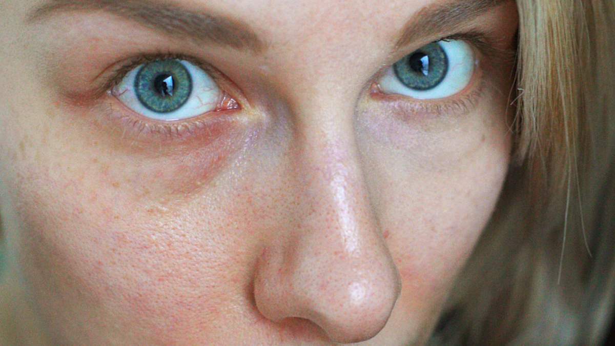 best vitamin c serum for broken capillaries