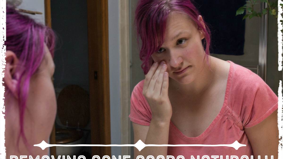 best way to remove acne scars at home