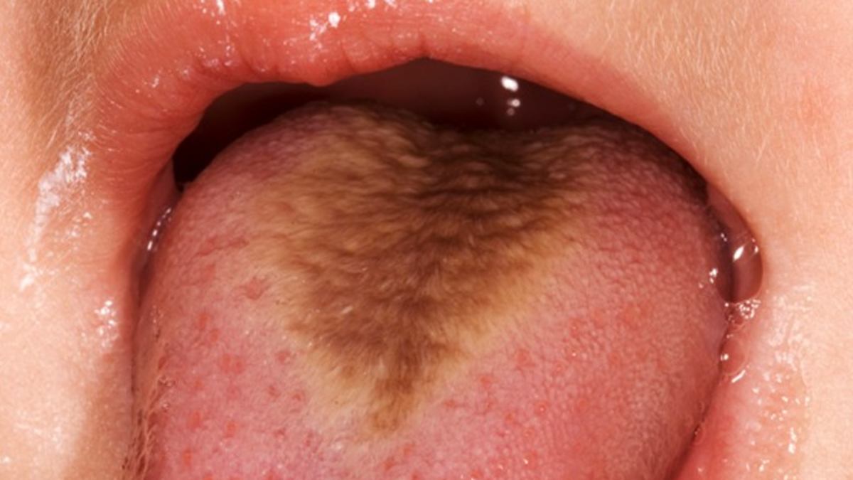 hairy tongue from smoking cigarettes Smoker's sprouts green hair after years of cigarette use A 64-year-old man with current