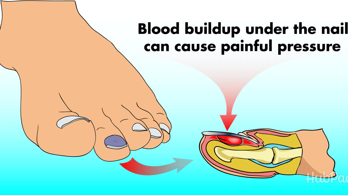 How To Treat A Blood Blister Under The Nail Youmemindbody