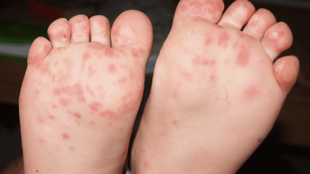 causes of red dots on feet