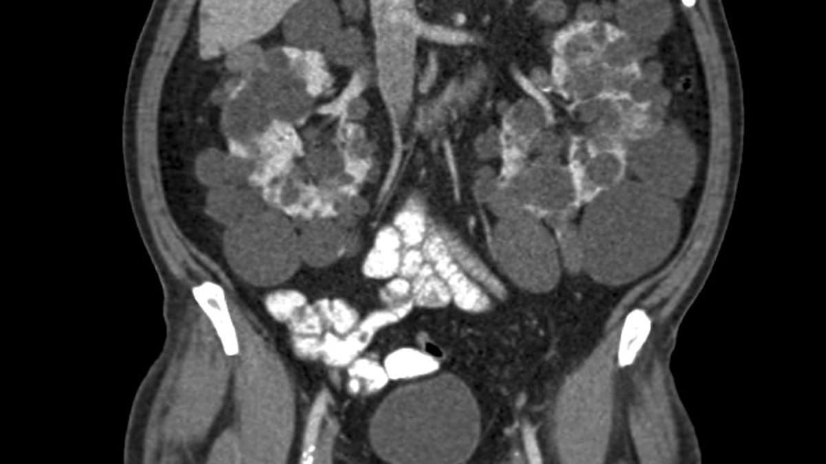 CT Scan of the Abdomen and Pelvis: With and Without Contrast