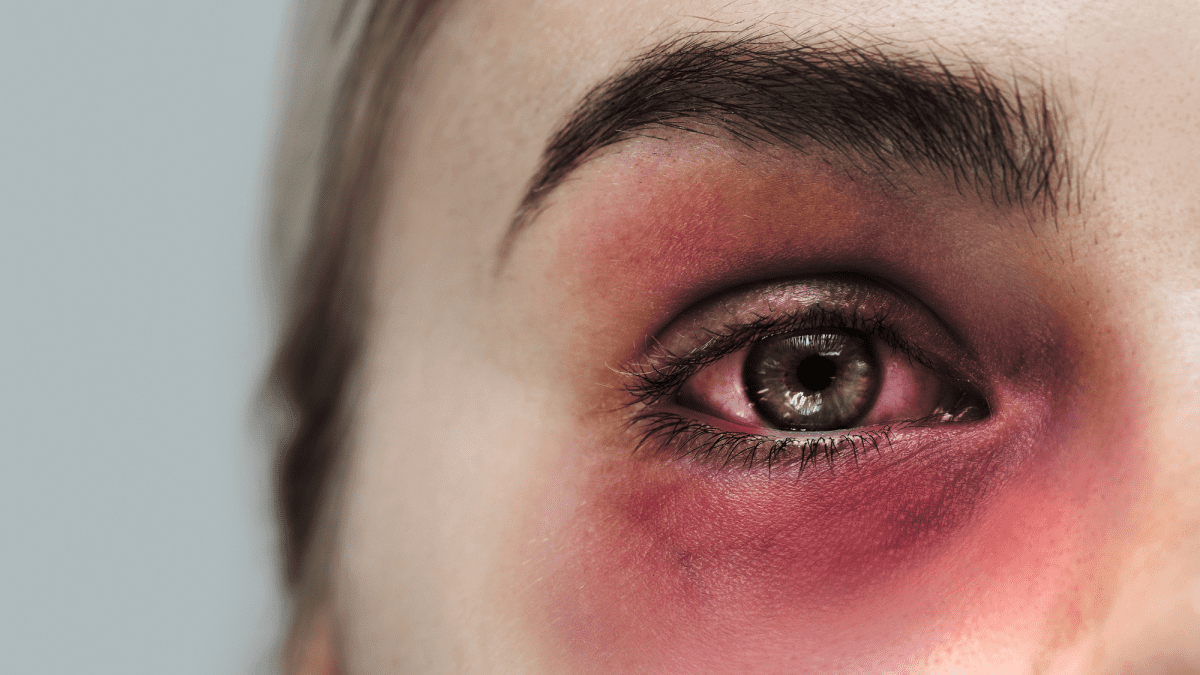 How to Cover a Black Eye With Makeup - Bellatory