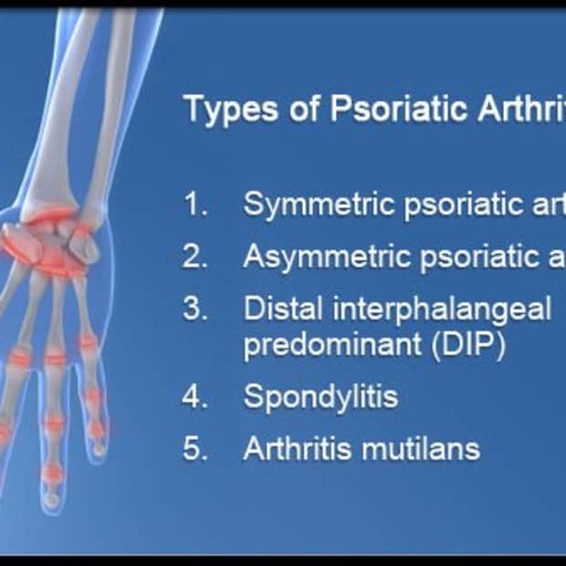 psoriatic-arthritis-arthritis-symptoms-and-arthritis-treatment