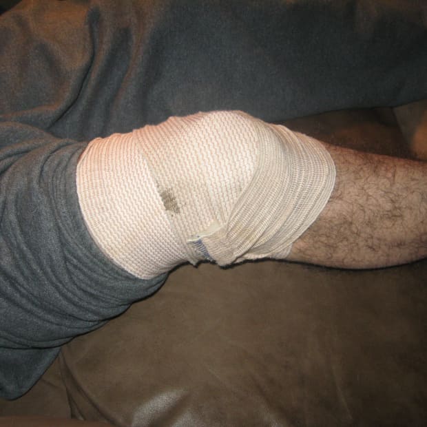 torn-meniscus-my-experience