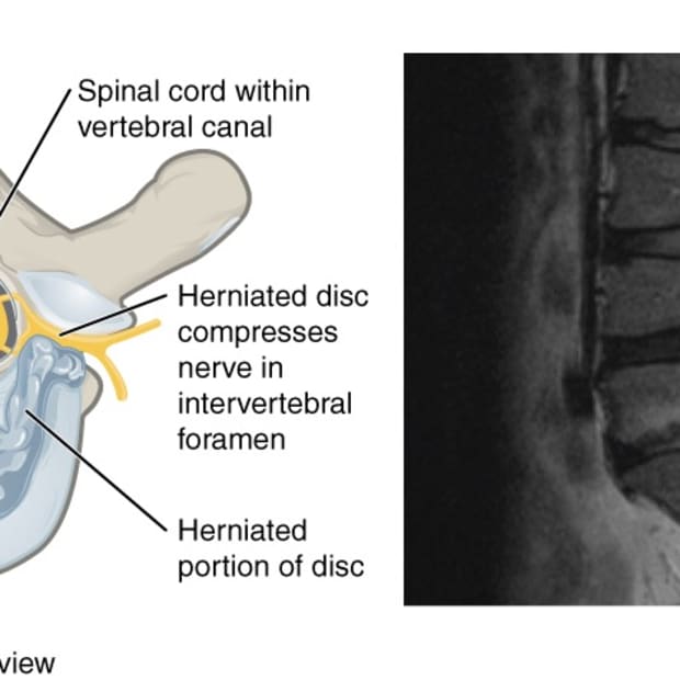 herniated-or-slipped-disks-bacteria-and-back-pain
