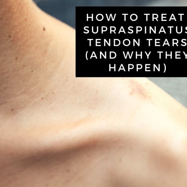 supraspinatus-tendon-tear