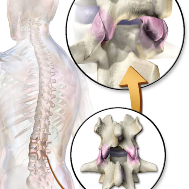 injections-for-back-pain-facet-injections-or-medial-branch-blocks-and-radiofrequency-ablation