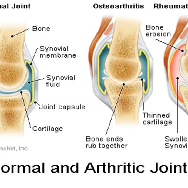 living-with-spinal-shoulder-hand-and-wrist-osteoarthritis