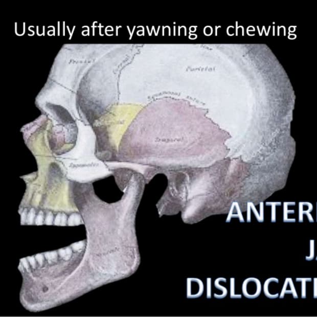 tmj-temporomandibular-joint-disorder-tmj-dislocated-jaw