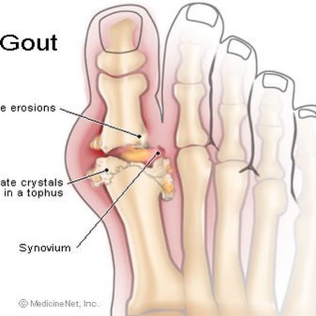 living-with-gout-a-lesson-in-self-discipline