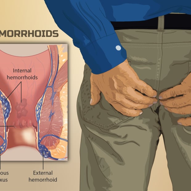 hemorrhoids-or-piles-dos-and-donts