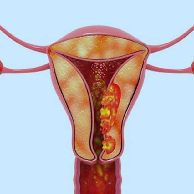 surviving-endometrial-cancer
