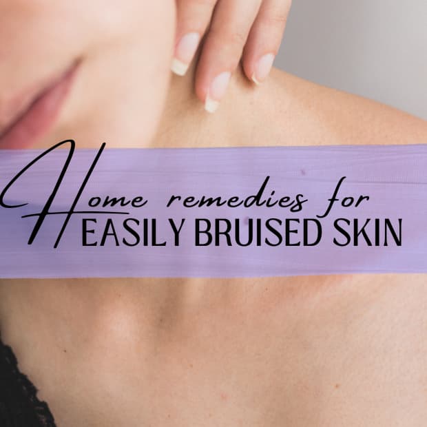 easy-bruising-and-thin-skin-the-causes-and-some-self-help-ideas