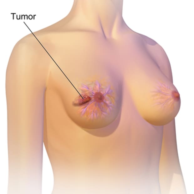 breast-cancer-risk-factors-symptoms-treatments