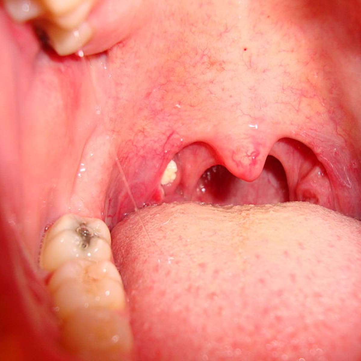 Swollen Tonsils With White Spots And Swollen Glands