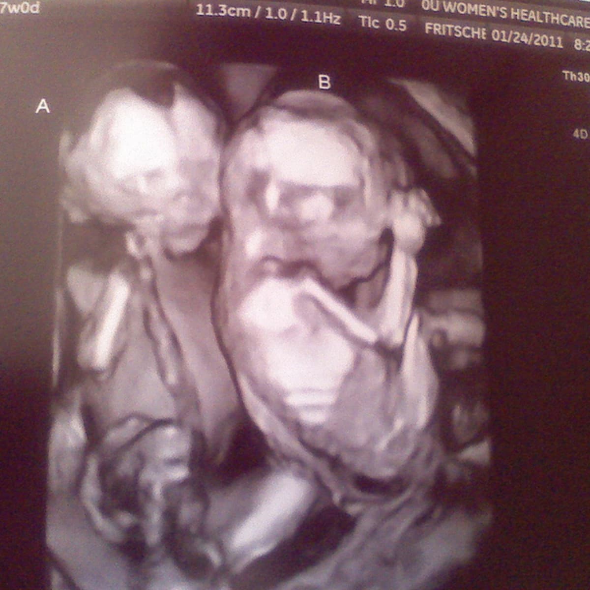 Pictures ultrasound missed twin 20 Weeks