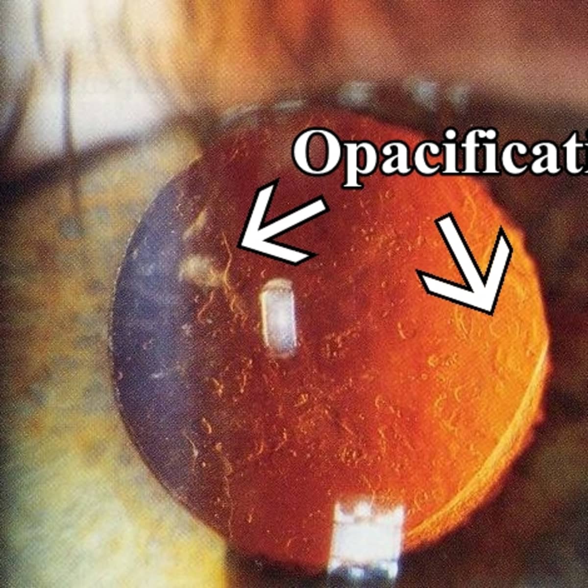 Мыть голову после операции катаракты. Дисцизия задней капсулы хрусталика. Вторичная катаракта фиброз задней капсулы. Плавающая мембрана после дисцизии вторичной катаракты.